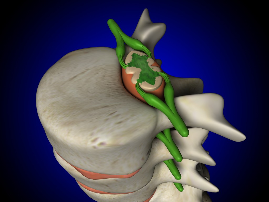 Living With Arachnoiditis - Causes, Symptoms