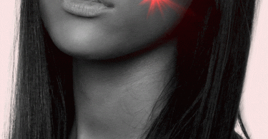 Fraxel Laser Treatment