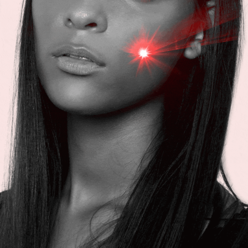 Fraxel Laser Treatment
