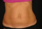 Myths About Coolsculpting