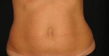Myths About Coolsculpting