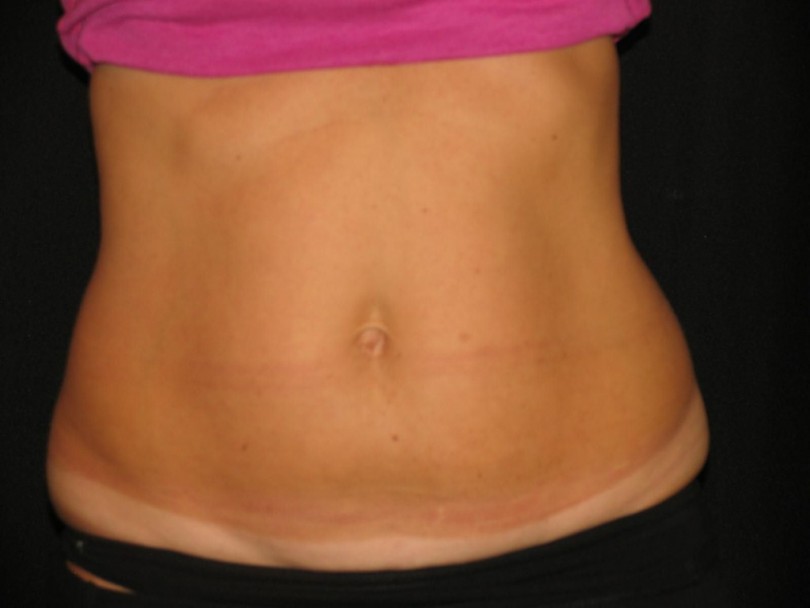 Myths About Coolsculpting