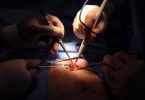 laparoscopic hernia repair