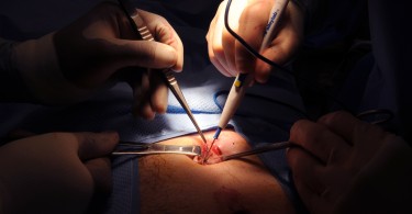 laparoscopic hernia repair