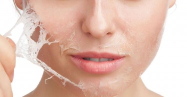 Chemical Peel