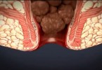 Internal Piles