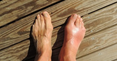 Swollen Toes