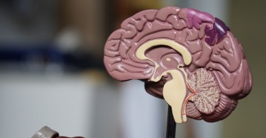 Epidural Hematoma Cerebral Palsy