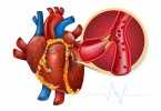 Coronary Artery Disease Symptoms: Here's What To watch Out For