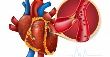 Coronary Artery Disease Symptoms: Here's What To watch Out For