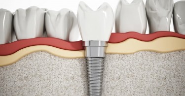 Dental Implants
