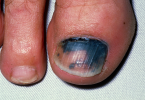 Ridges On Toenails
