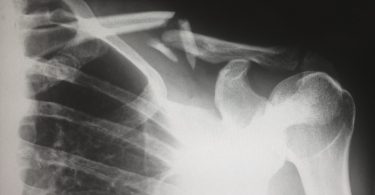 Personal Injury Lawyer in Allentown