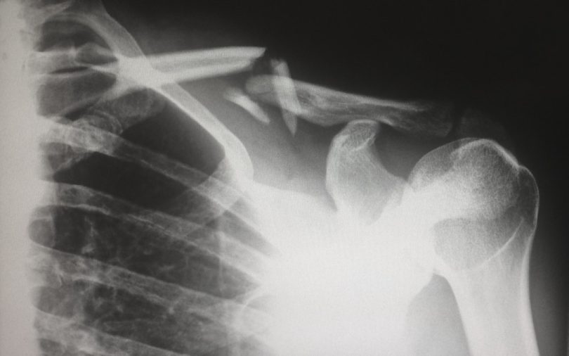Personal Injury Lawyer in Allentown